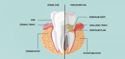 Parodontopatija: Zbog čega se javlja i  kako se leči?