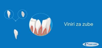  Viniri za zube i održavanje oralne higijene